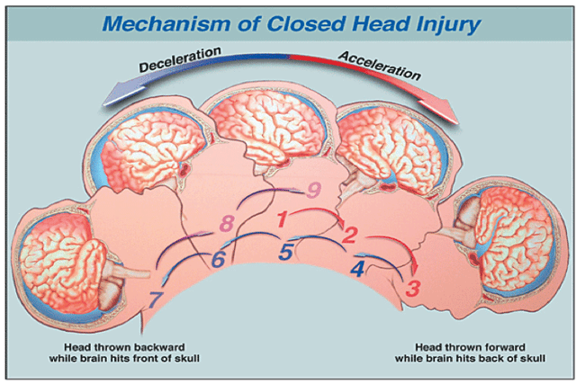 how-the-pituitary-gland-is-damaged-during-a-brain-injury